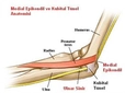 Ulnar Sinir Belirtileri ve Tedavisi
